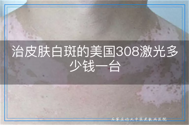 治皮肤白斑的美国308激光多少钱一台