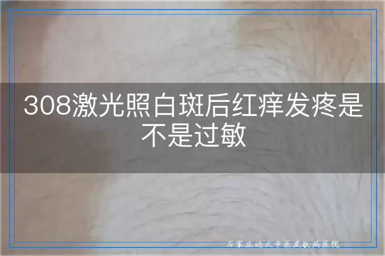 308激光照白斑后红痒发疼是不是过敏