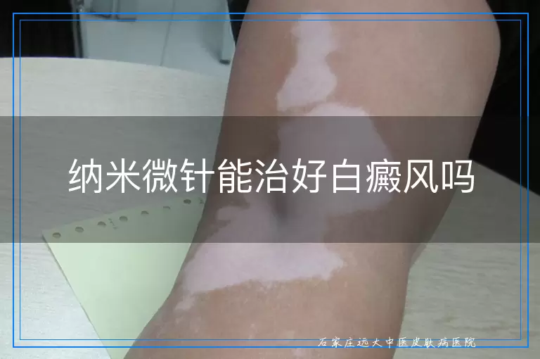 纳米微针能治好白癜风吗