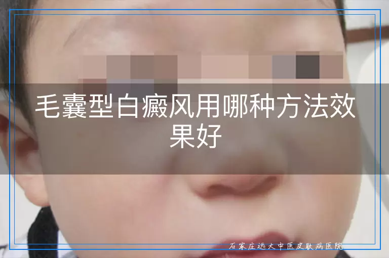 毛囊型白癜风用哪种方法效果好