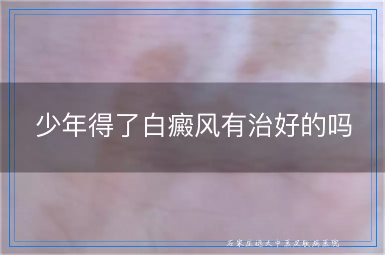 少年得了白癜风有治好的吗