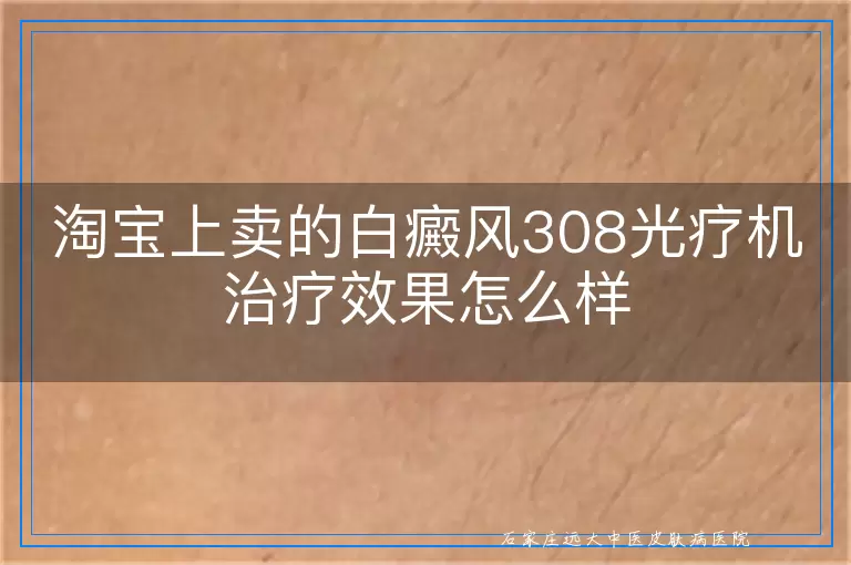 淘宝上卖的白癜风308光疗机治疗效果怎么样