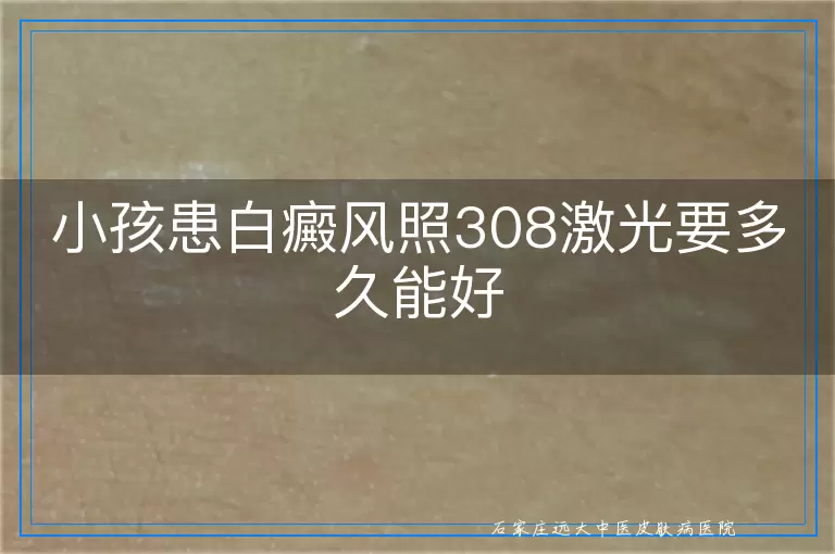 小孩患白癜风照308激光要多久能好