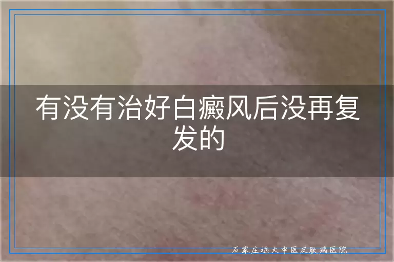 有没有治好白癜风后没再复发的