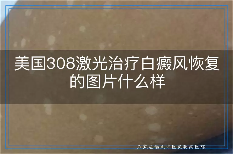 美国308激光治疗白癜风恢复的图片什么样