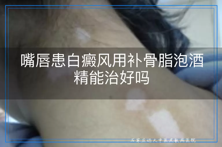 嘴唇患白癜风用补骨脂泡酒精能治好吗