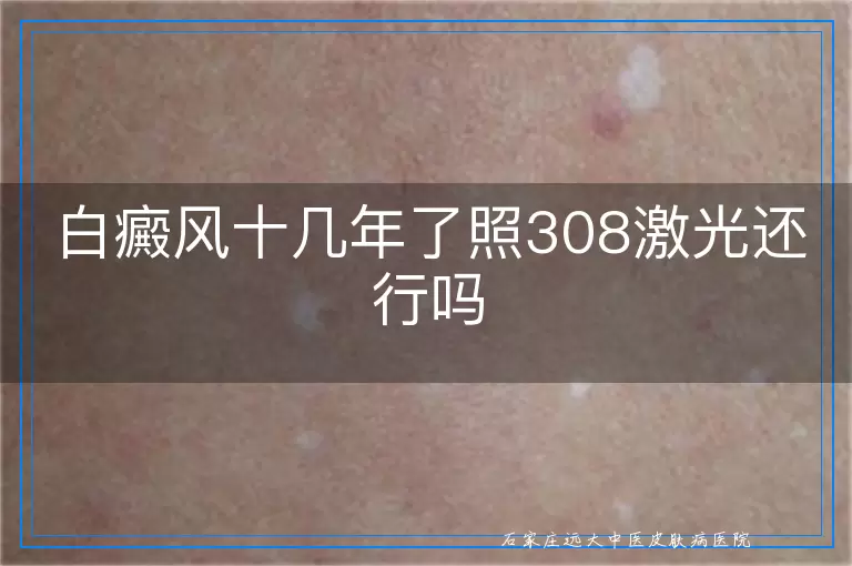 白癜风十几年了照308激光还行吗