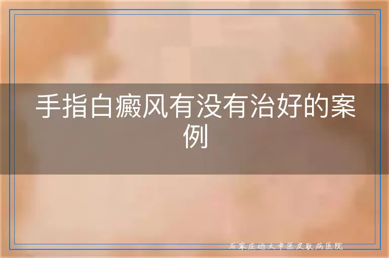 手指白癜风有没有治好的案例