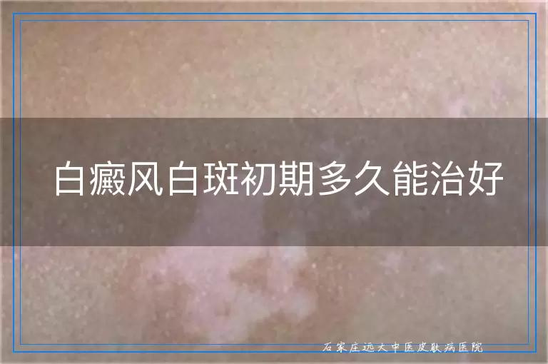 白癜风白斑初期多久能治好