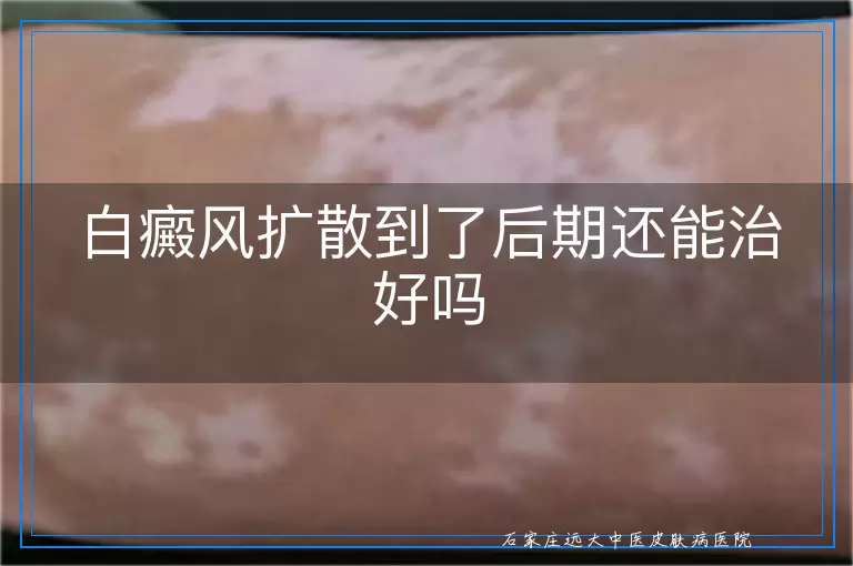 白癜风扩散到了后期还能治好吗