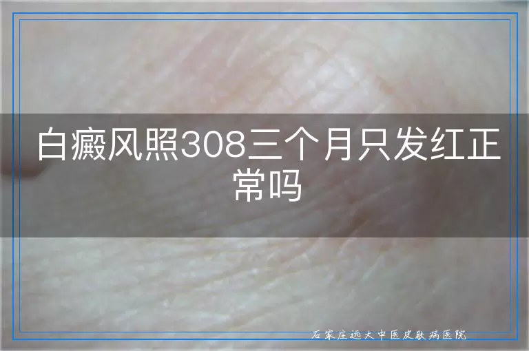 白癜风照308三个月只发红正常吗