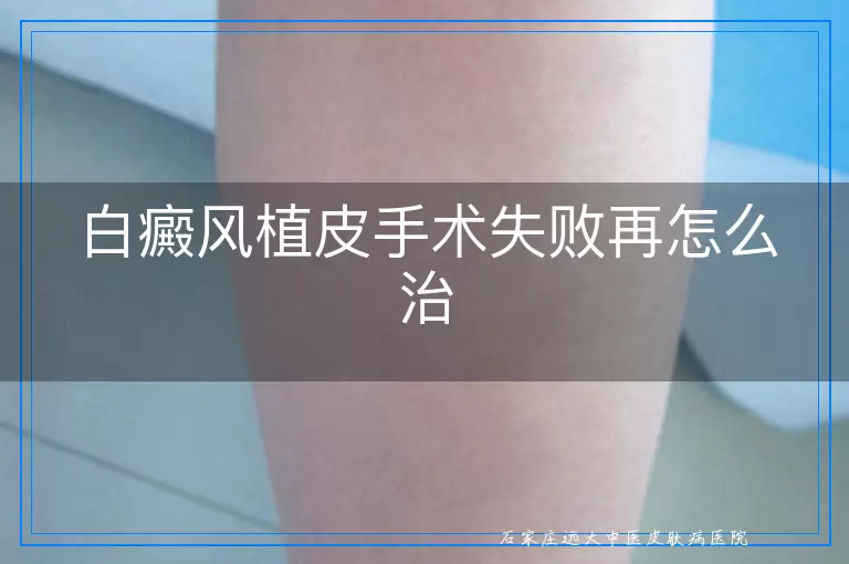 白癜风植皮手术失败再怎么治