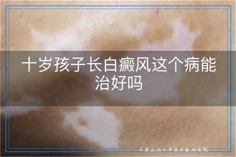 十岁孩子长白癜风这个病能治好吗