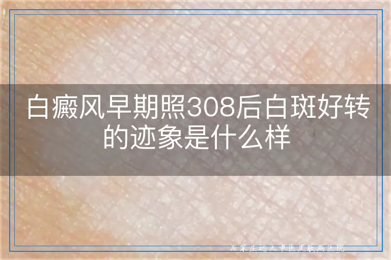 白癜风早期照308后白斑好转的迹象是什么样