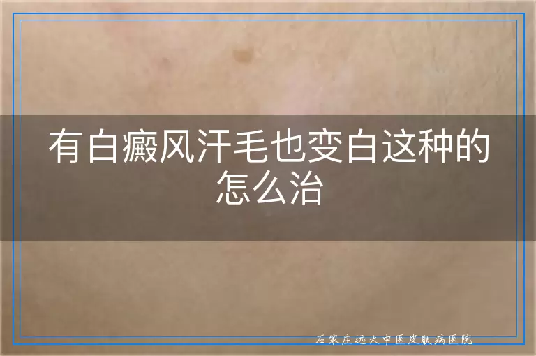 有白癜风汗毛也变白这种的怎么治