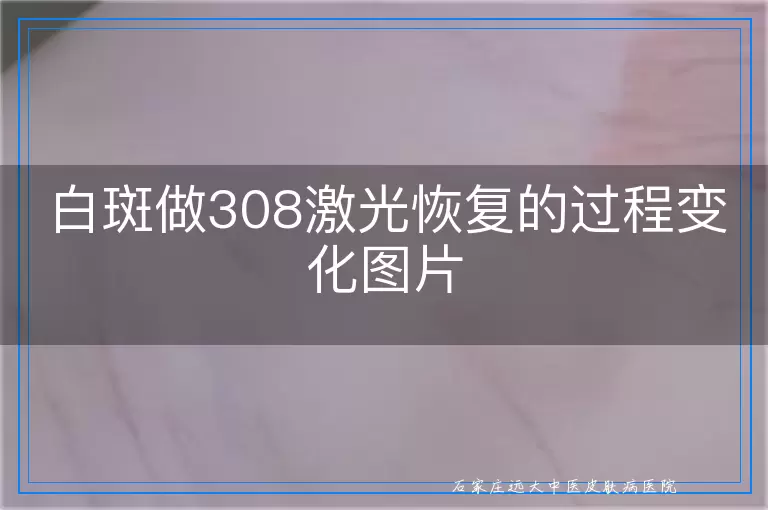 白斑做308激光恢复的过程变化图片
