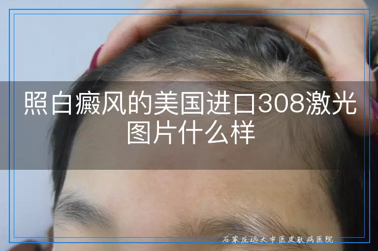 照白癜风的美国进口308激光图片什么样