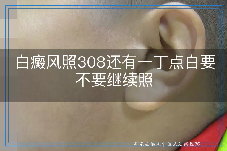 白癜风照308还有一丁点白要不要继续照