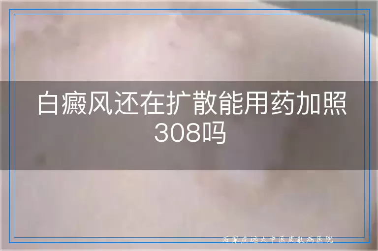 白癜风还在扩散能用药加照308吗