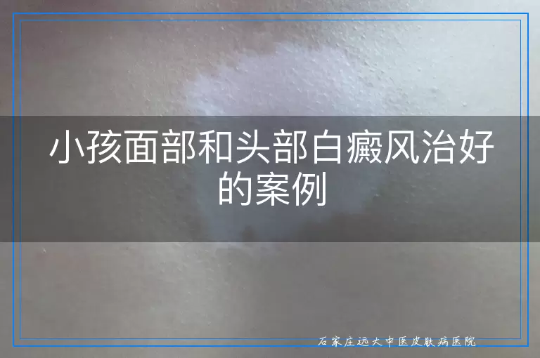 小孩面部和头部白癜风治好的案例