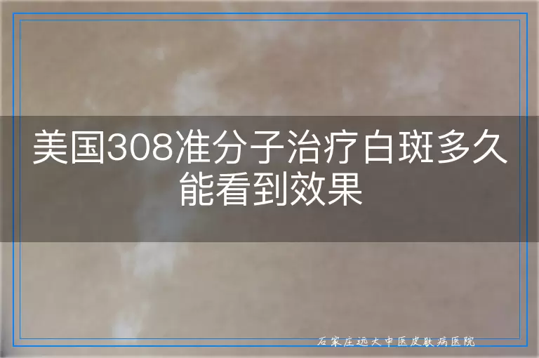 美国308准分子治疗白斑多久能看到效果