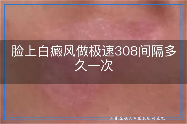 脸上白癜风做极速308间隔多久一次