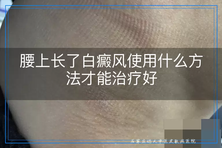 腰上长了白癜风使用什么方法才能治疗好