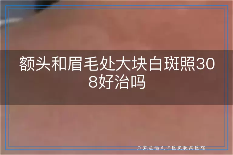额头和眉毛处大块白斑照308好治吗