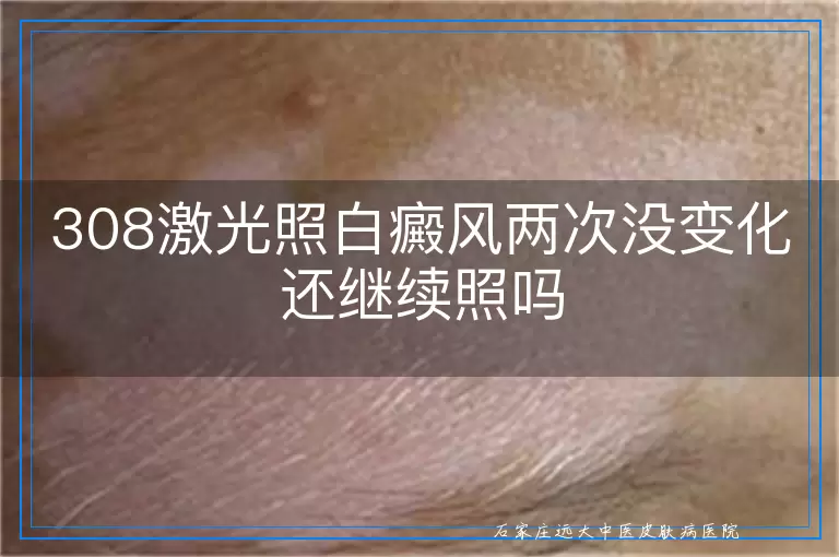 308激光照白癜风两次没变化还继续照吗