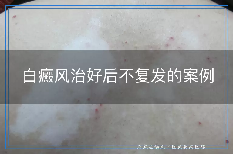 白癜风治好后不复发的案例