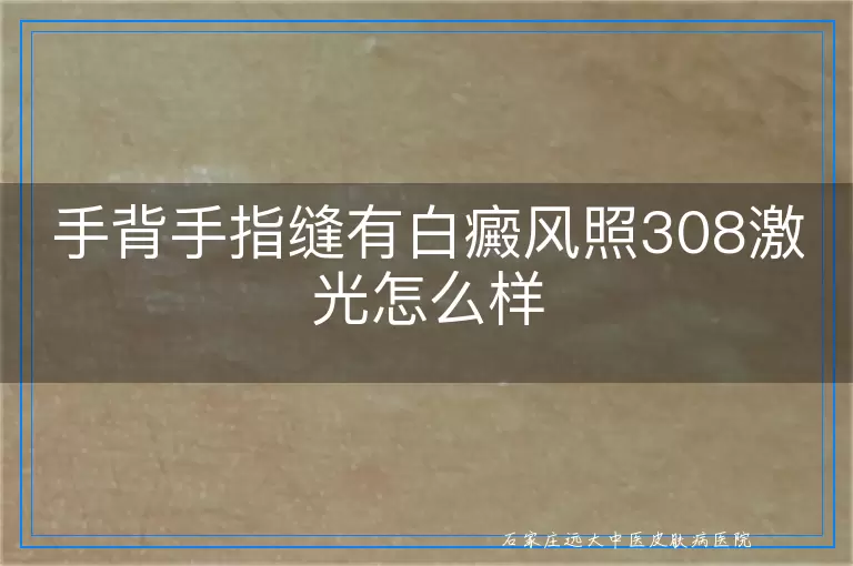 手背手指缝有白癜风照308激光怎么样