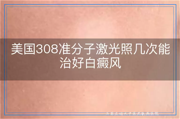 美国308准分子激光照几次能治好白癜风