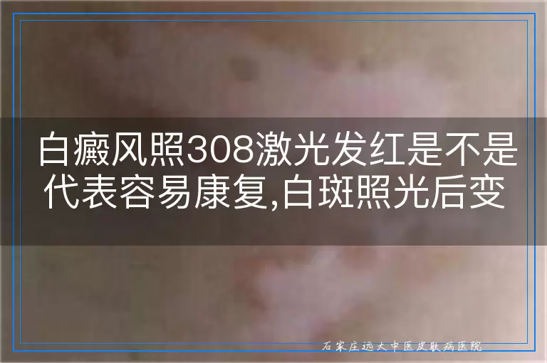 白癜风照308激光发红是不是代表容易康复,白斑照光后变红是否意味着治疗效果好易恢复,白癜风患者308治疗发红现象与康复难易关系