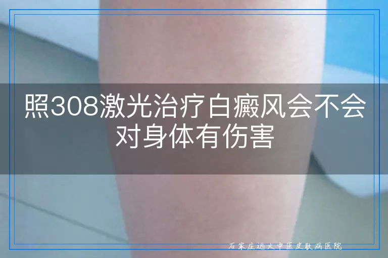 照308激光治疗白癜风会不会对身体有伤害
