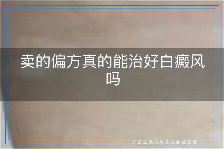 卖的偏方真的能治好白癜风吗