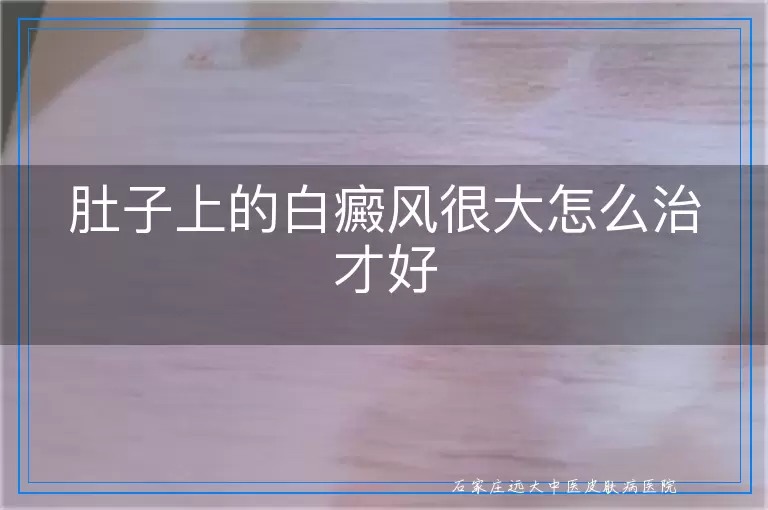 肚子上的白癜风很大怎么治才好