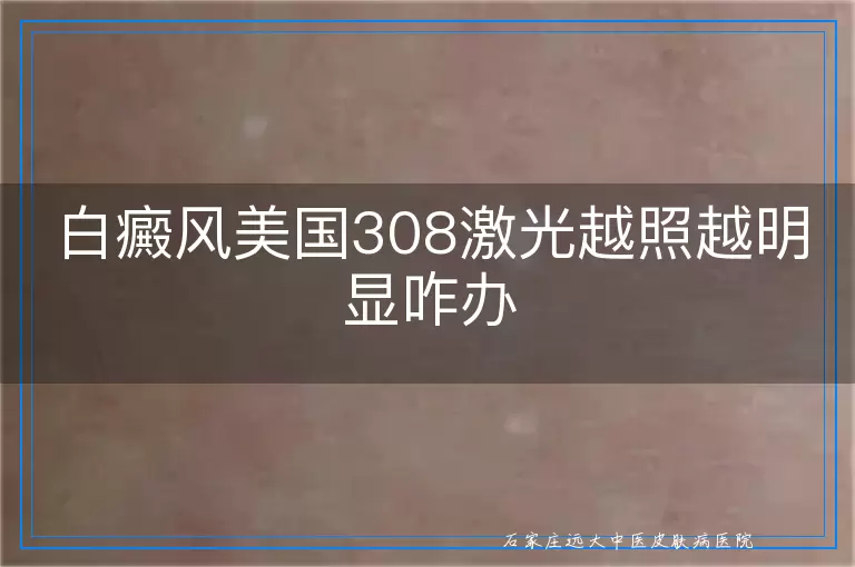 白癜风美国308激光越照越明显咋办