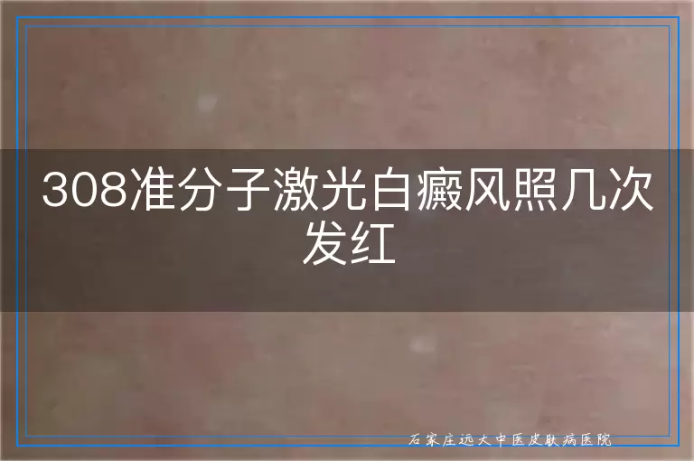 308准分子激光白癜风照几次发红