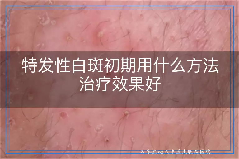特发性白斑初期用什么方法治疗效果好