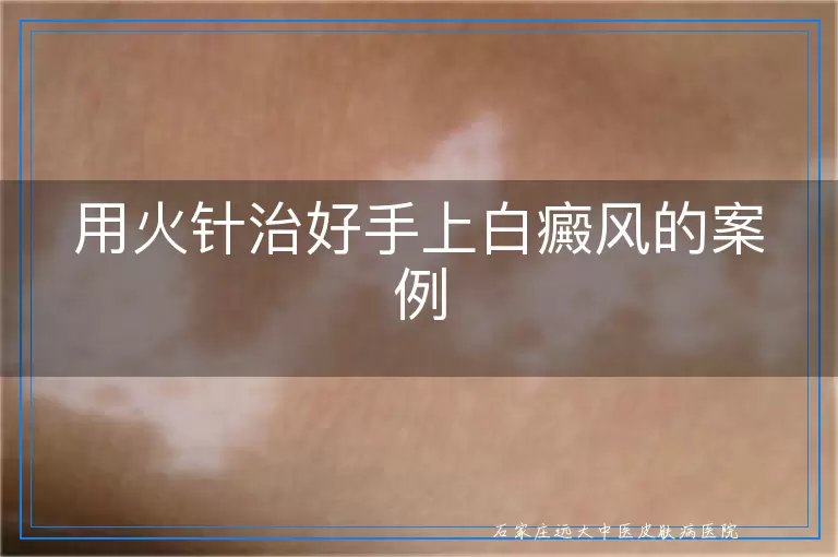 用火针治好手上白癜风的案例