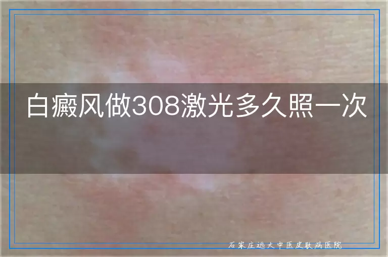 白癜风做308激光多久照一次