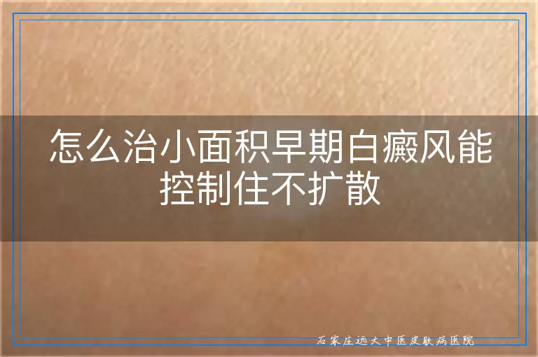 怎么治小面积早期白癜风能控制住不扩散