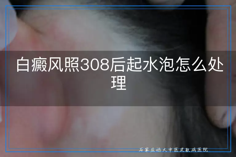白癜风照308后起水泡怎么处理