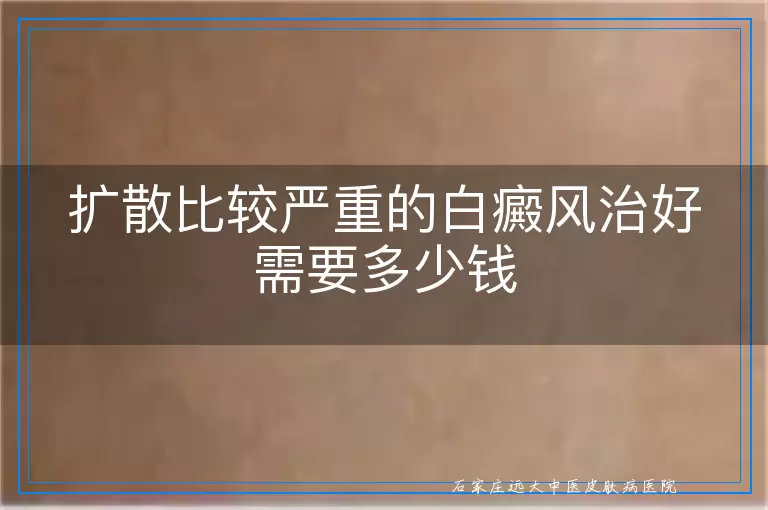 扩散比较严重的白癜风治好需要多少钱