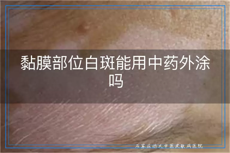 黏膜部位白斑能用中药外涂吗