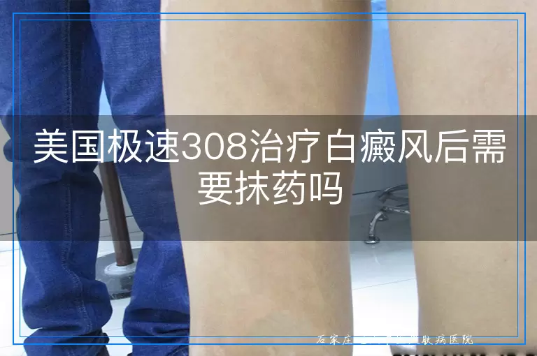美国极速308治疗白癜风后需要抹药吗