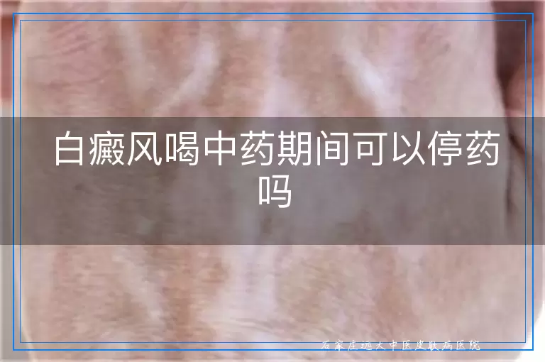 白癜风喝中药期间可以停药吗