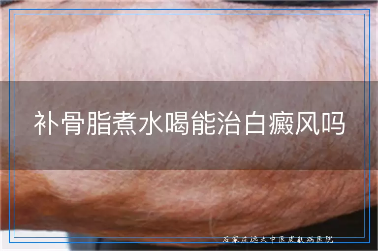 补骨脂煮水喝能治白癜风吗