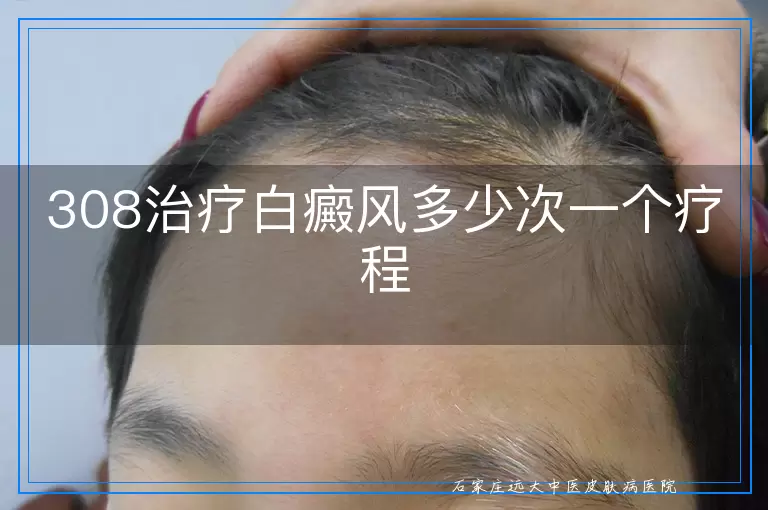 308治疗白癜风多少次一个疗程