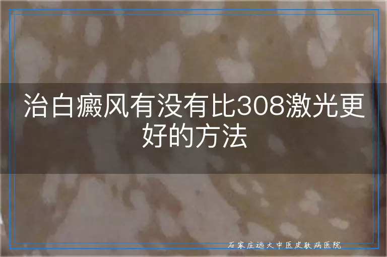 治白癜风有没有比308激光更好的方法